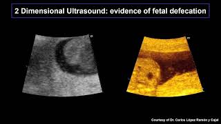 12  Meconiumstained amniotic fluid [upl. by Finer]