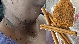 Remove skin tags naturally fast in 3 night with cinnamon  diy skin tag removal home remedy [upl. by Joann]