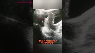 Early pregnancy UltrasoundIntrauterine gestational sacfypviraltrendingshortsforyouultrasound [upl. by Roddy302]