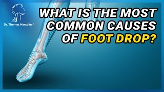 What are the Causes of Foot Drop Syndrome [upl. by Kcirddot]