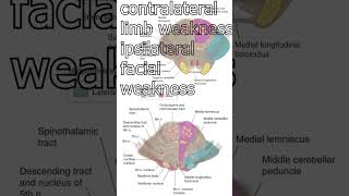 infarction of pons medial and lateral pons shorts [upl. by Normy]