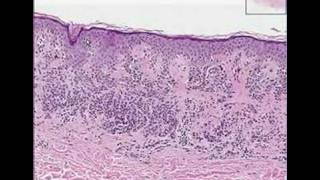 Histopathology SkinCompound Clarks nevus dysplastic nevus [upl. by Nosnej]