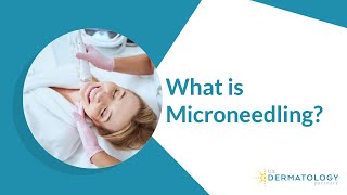 What is Microneedling  Microneedling Treatment [upl. by Eselahs]