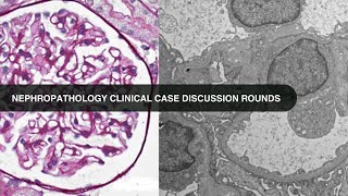 20240820 Nephropathology Clinical Case Discussion Rounds [upl. by Kaia]