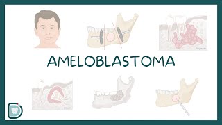 Understanding Ameloblastoma Causes Diagnosis Types and Treatment [upl. by Corb]