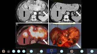 Adenomas Hepatocelulares [upl. by Hamlani]