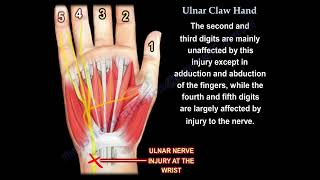 Ulnar Claw Hand Deformity Diagnosis Causes and Differential Diagnosis [upl. by Uria]