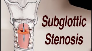 Adult Subglottic Stenosis Treatment [upl. by Chatav]