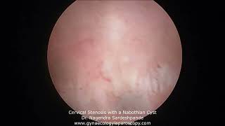 Cervical stenosis with a Nabothian cyst [upl. by Olraced]