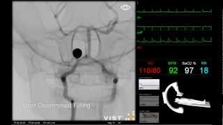 Mentice  Neuro Intervention [upl. by Ttennej]