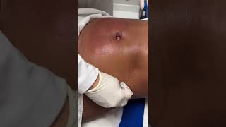 Coolsculpting  Clínica Luciana Hitomi procedimentosesteticos [upl. by Plato76]