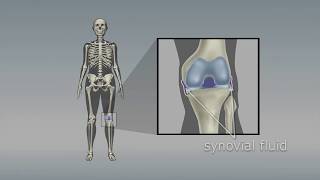 Osteoarthritis of the knee Choosing the right pain medicine [upl. by Burchett]