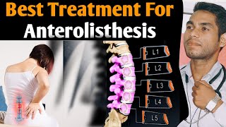 anterolisthesis l5 s1 treatment Spondylolisthesis grade 1 treatment exercises grade 2 l4 L5 Hindi [upl. by Notyrb96]