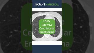 🔍 CT Scans Unveiled Centrilobular Emphysema Emphysema Radiology usmle copd [upl. by Ellevehs293]