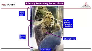 Infectious module pathology Tuberculosis  sarcoidosis  granuloma  part 2 [upl. by Jacy]