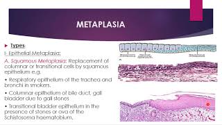 Disorders of growth and neoplasia  metaplasia dysplasia and carcinoma in situ [upl. by Eimrots967]