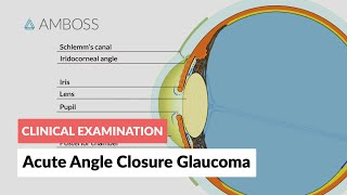 Acute Angle Closure Glaucoma [upl. by Inneg]