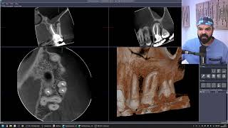 ENDOCAST  RETRATAMENTO ENDODÔNTICO DE UM DENTE 26 SOB A ÓTICA DA ENDODONTIA CONTEMPORÂNEA [upl. by Aseret]