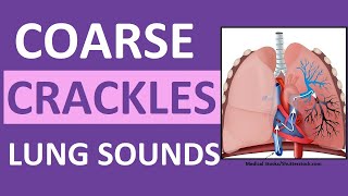 Crackles Coarse Lung Sounds  Crackles and Rales Breath Sounds Abnormal [upl. by Llenaej24]