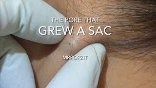 The pore that grew a sac Yellow pasty cyst pop Cyst excision on neck MrPopZit [upl. by Enimrac]