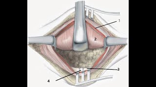 Transverse Pfannenstiel incision [upl. by Attalie]