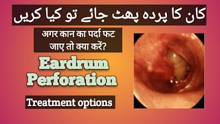 Perforated eardrum treatment  Ruptured eardrum  Kaan ka parda phat jaye to kya kare [upl. by Atinaujnas952]