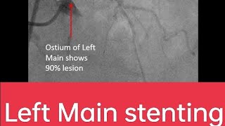 Left main PCI PTCA Stenting angiogram cardiology Intervention cardiology [upl. by Duky1]