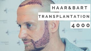 Haartransplantation und Barttransplantation in Istanbul Erfahrung [upl. by Ayahsey]