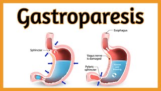 Gastroparesis [upl. by Krusche]