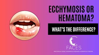 Whats the difference between a Bruise ecchymosis and a hematoma [upl. by Bary]