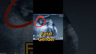 Easy Fetal Ultrasound  Gender Revealing  Anomaly Scan  3rd Trimester Third [upl. by Orestes]