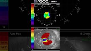 Radial Keratotomy with Over 12 Diopters of Irregular Astigmatism amp the Daytona Race Track 🏎️ [upl. by Danice]