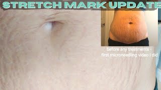 Stretch Mark Update  Car Accident  Avologi Eneo Advanced [upl. by Kirsti]