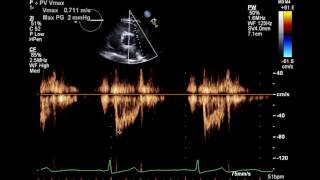 Normal Complete 2D Echocardiogram with Color Doppler and Spectral Doppler [upl. by Argent]