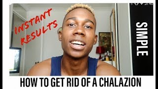 HOW TO GET RID OF A CHALAZION  instant results [upl. by Auston]