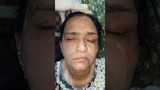 बेल्स पारसी Bels palsy treatment ayurvedalifestyleExcercise [upl. by Assille]