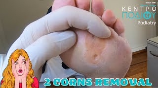 2 Corns RemovalΑφαίρεση 2 τύλων callus κεντροποδιου footcare podologos podiatrist podiatry [upl. by Elita785]