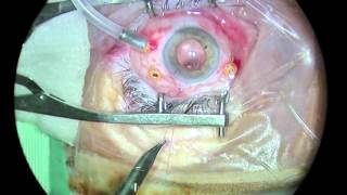 Vitrectomy Dropped Lens Nucleo Luxado  Vitrectomía [upl. by Olecram]