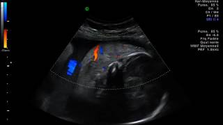 Lymphangiome cervical [upl. by Stimson]