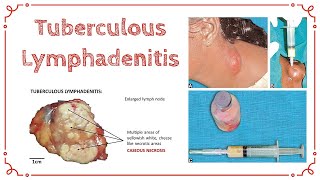 TUBERCULOUS LYMPHADENITIS  Stages Of TB Lymphadenitis  Cold Abscess  General Surgery [upl. by Muriel]