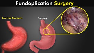 How Fundoplication Procedure Is Performed To Treat GERD or Acid reflux [upl. by Letnahc]