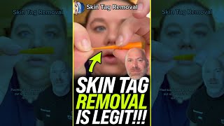 Skin Tag Removal is LEGIT 😱 shorts [upl. by Mckeon340]