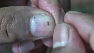 Nails Pressure Lice Kill  ASMR LICE POPPING SOUNDS [upl. by Arised856]