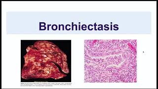 Bronchiectasis [upl. by Huxley176]