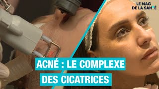 Le LASER  une solution contre lacné  Allo Docteurs [upl. by Eirek439]