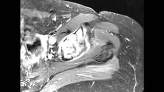 Chondrosarcoma of the Acetabulum [upl. by Odrarej154]