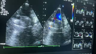 Truncus arteriosus  tricuspid valve attesia [upl. by Nonregla403]