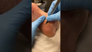 Watch a Podiatrist Remove Hard Skin and Calluses from the Midfoot using Ergonx and Docpods [upl. by Tabor]