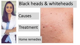 How to remove blackheads amp whiteheads Causes Treatment  Home remedies dermatologist [upl. by Ardnal]