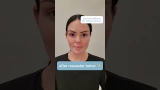 MASSETER BOTOX BEFORE AND AFTER [upl. by Gaylord]